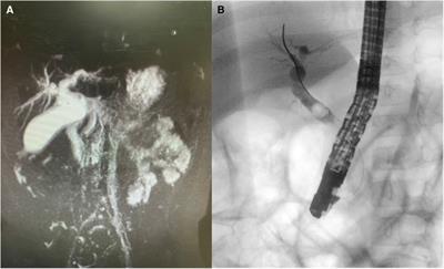 Rhabdomyosarcoma of the biliary tract in a child: a case report